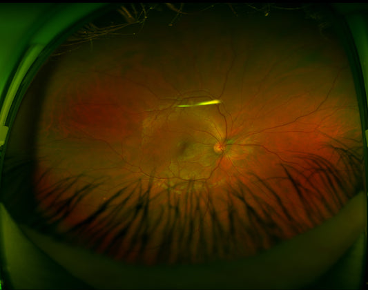 The Effects of Dyslexia and Visual Stress on Your Vision.